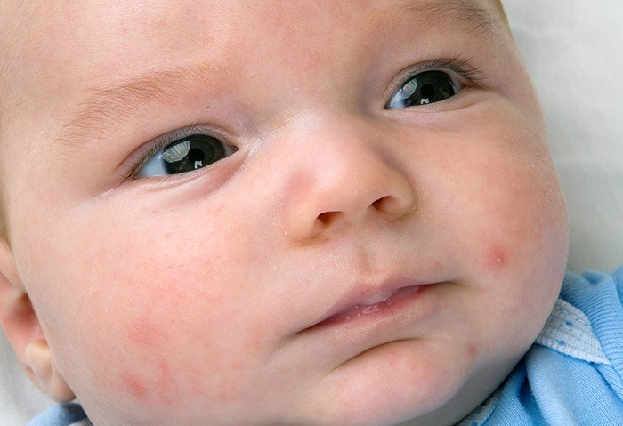 Bebeklerde Göz Sulanması Neden Olur? Sebepleri ve Tedavisi Nedir?